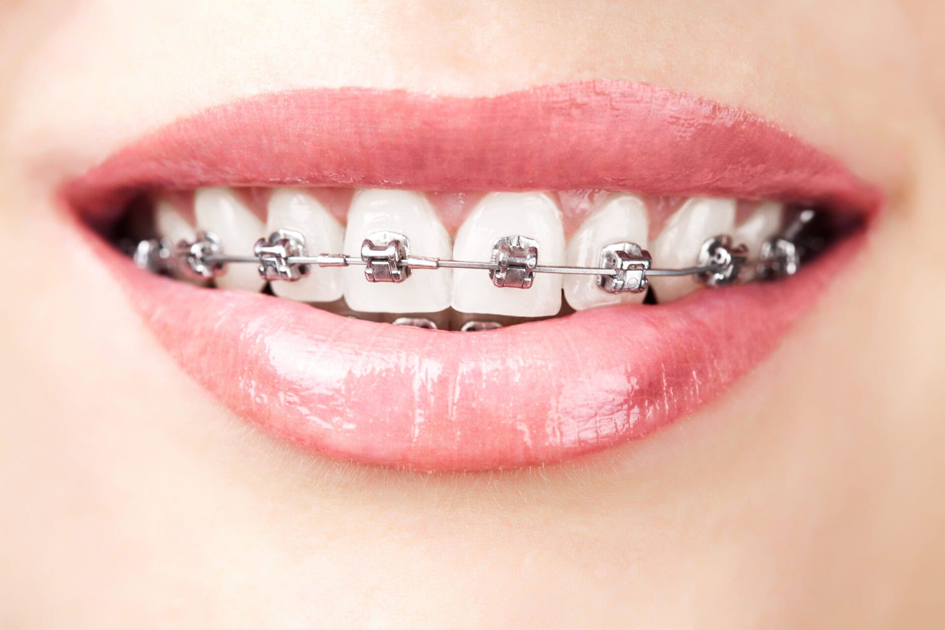 SmilePerfect Orthodontics Cedar Hills UT