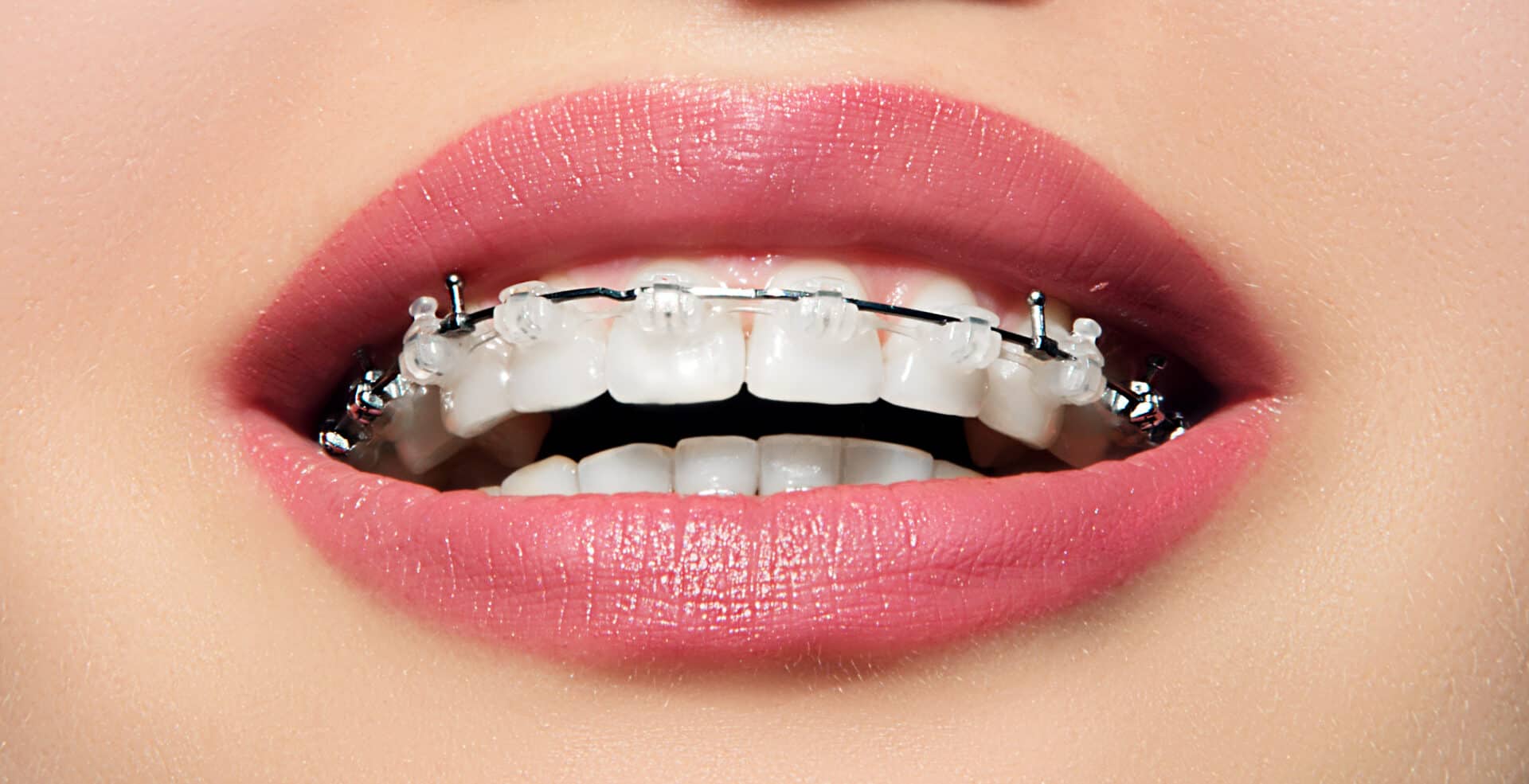 Closeup female smile with ceramic braces teeth. Orthodontic treatment. Open mouth with clear brackets.